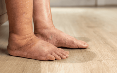 Linfedema agli arti inferiori